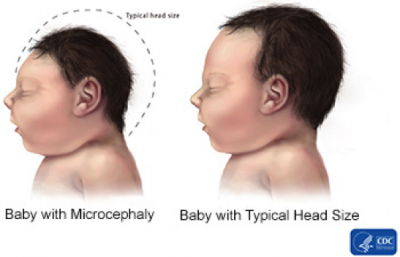 Description: Microcephaly versus normal size head comparison