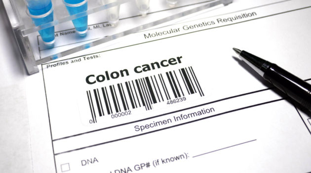 colon cancer