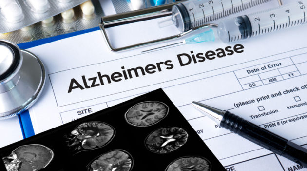 brain scan Alzheimers disease