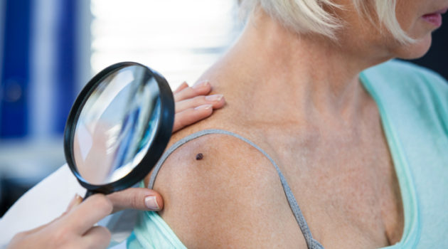 examining mole