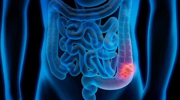 illustration highlighting colon.