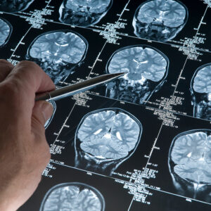 Brain scan imaging.