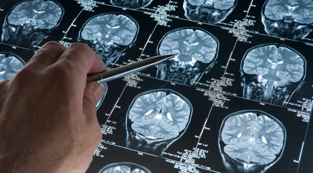 Brain scan imaging.